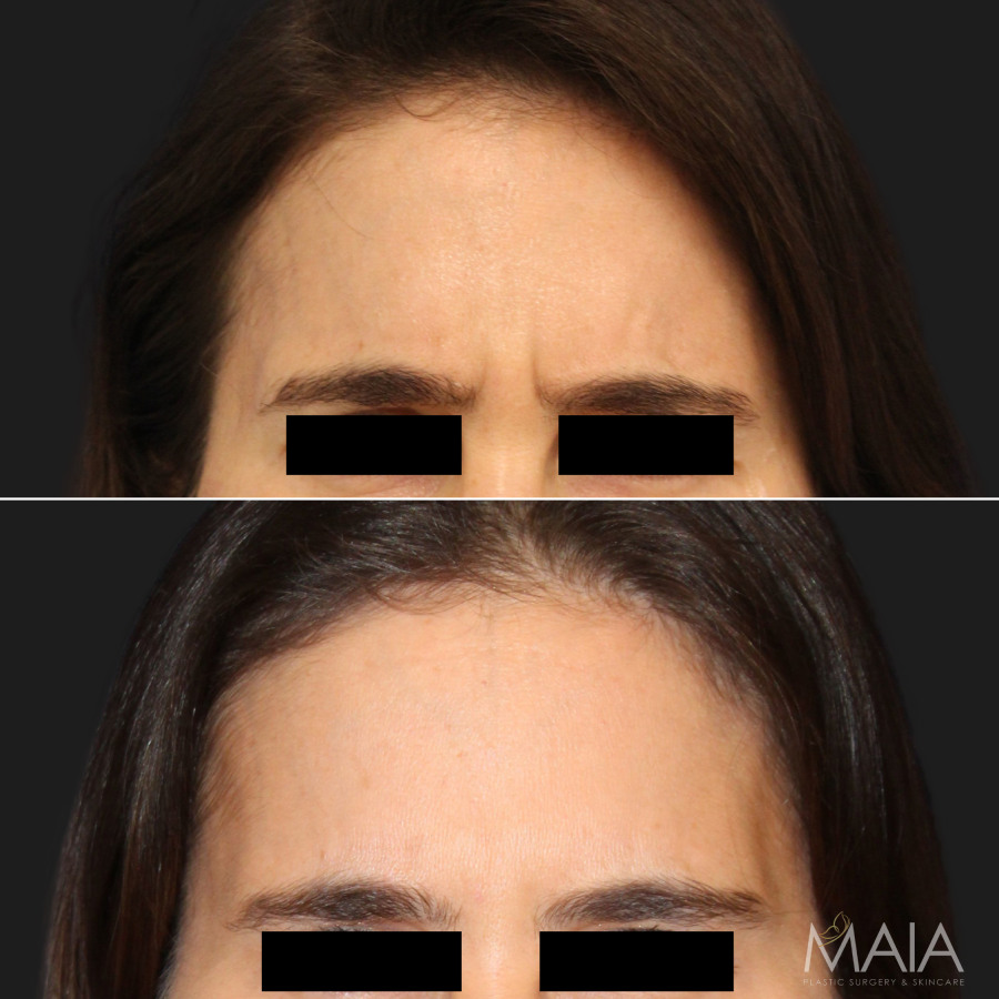 42 year-old before and after botox to the_ neck, eyebrows, forehead, glabella, and lip corners; Patient also underwent Morpheus8 microneedling, Jessner chemical peel, and medical-grade skincare treatment