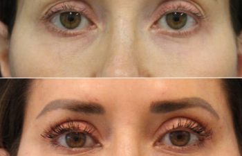 42 year-old patient 5 weeks post-op mini facelift, mini neck lift, and upper eyelid lift