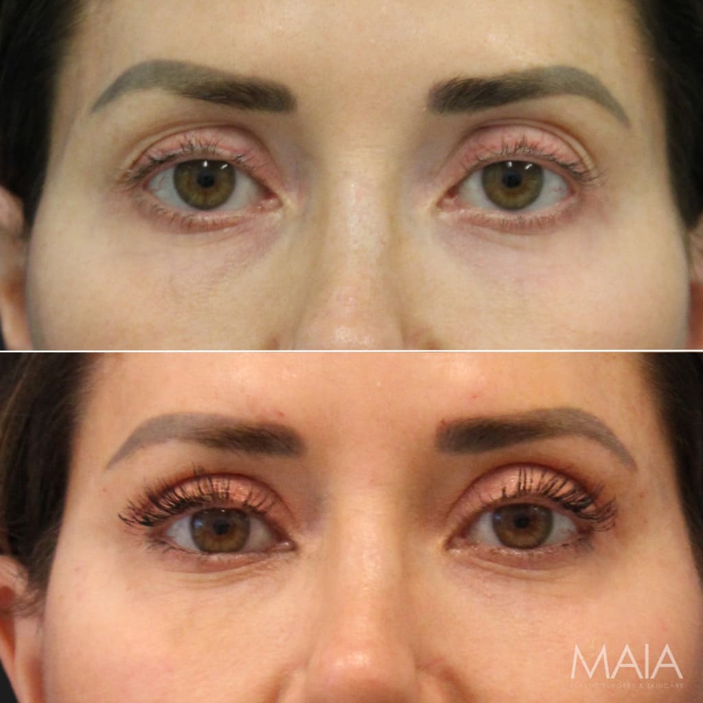 42 year-old patient 5 weeks post-op mini facelift, mini neck lift, and upper eyelid lift