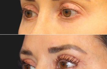 42 year-old patient 5 weeks post-op mini facelift, mini neck lift, and upper eyelid lift
