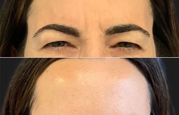 43 year-old before and 2 weeks after botox on the forehead, glabella, and crow's feet