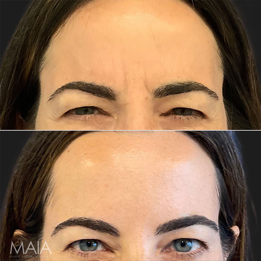 43 year-old before and 2 weeks after botox on the forehead, glabella, and crow's feet
