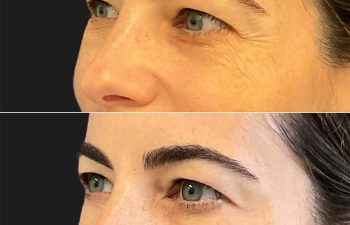 43 year-old before and 2 weeks after botox on the forehead, glabella, and crow's feet
