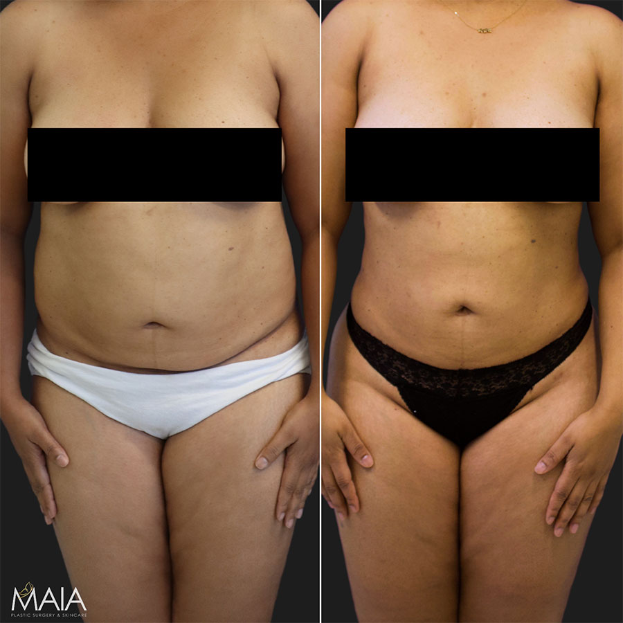 patient before and after liposution