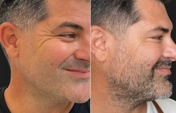 44 year-old male before and 1 week after Botox of the Crow's Feet