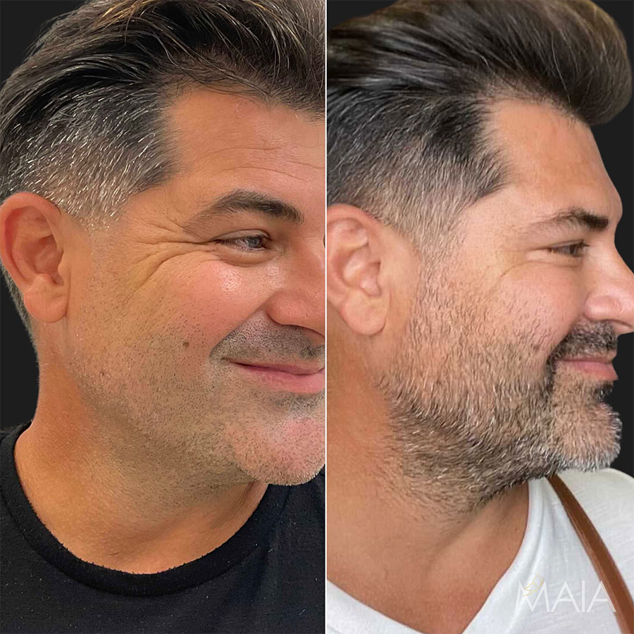 44 year-old male before and 1 week after Botox of the Crow's Feet