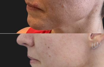 47 year-old patient before and after the MicroGold Infusion Facial. Pore size is noticeably smaller after and skin tone looks more even.