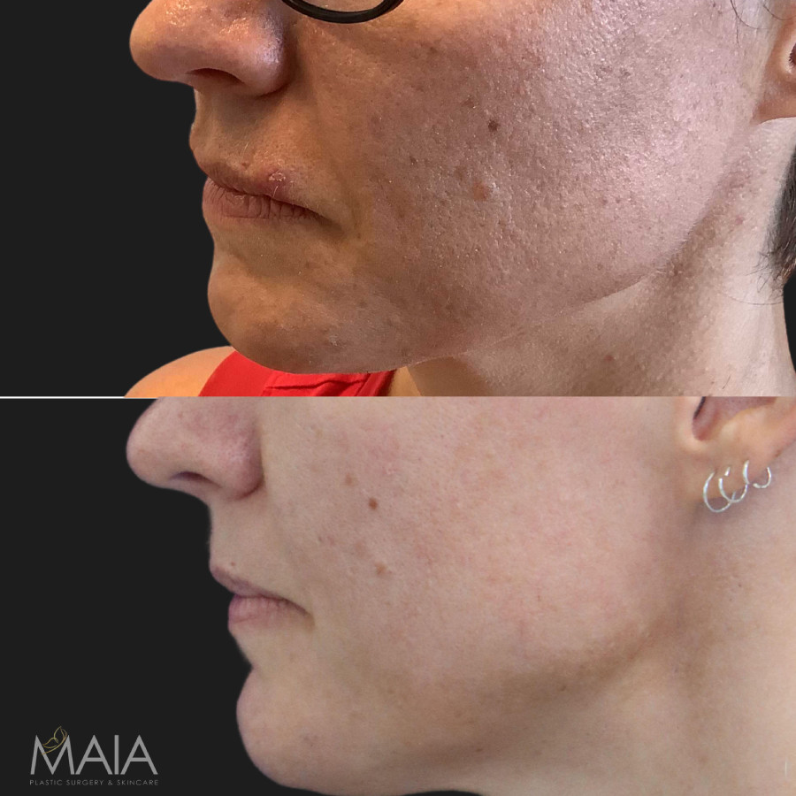 47 year-old patient before and after the AquaGold Facial. Pore size is noticeably smaller after and skin tone looks more even.