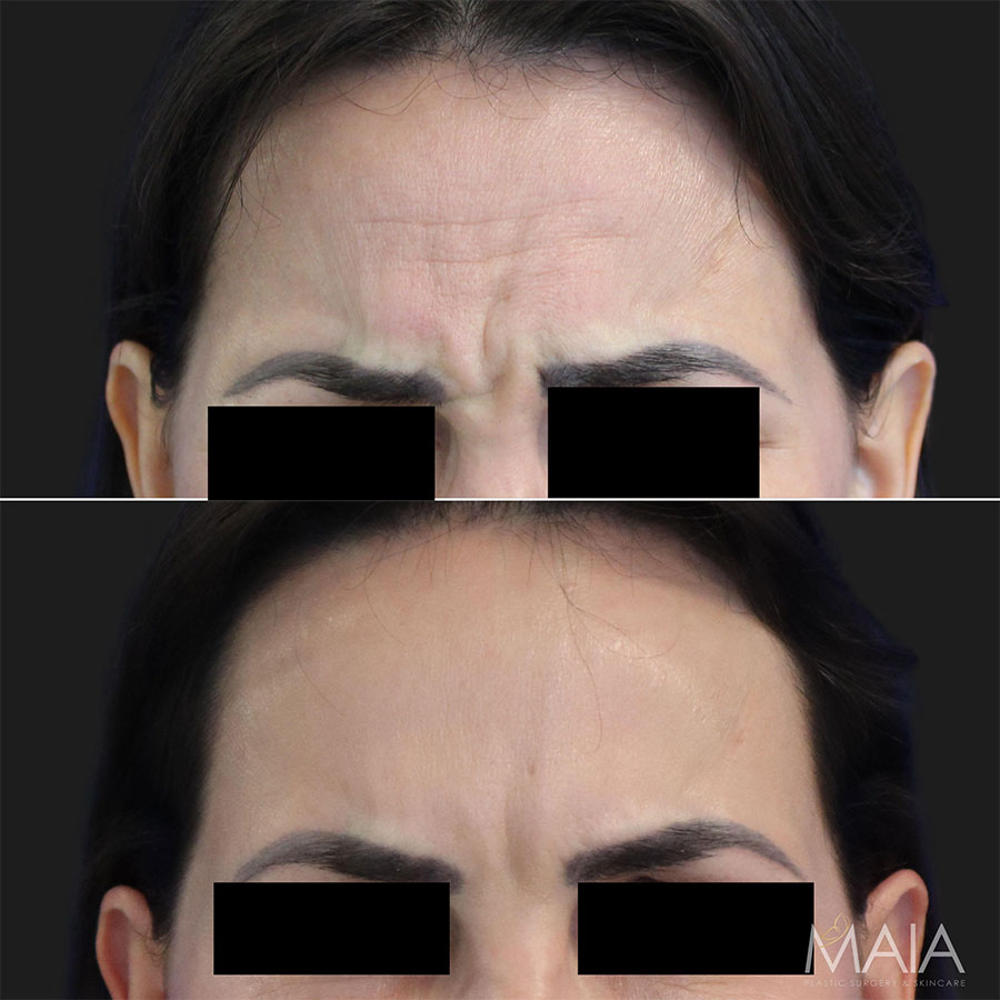 50 year-old female before and 2 weeks after Botox of the forehead, glabella, and crow's feet