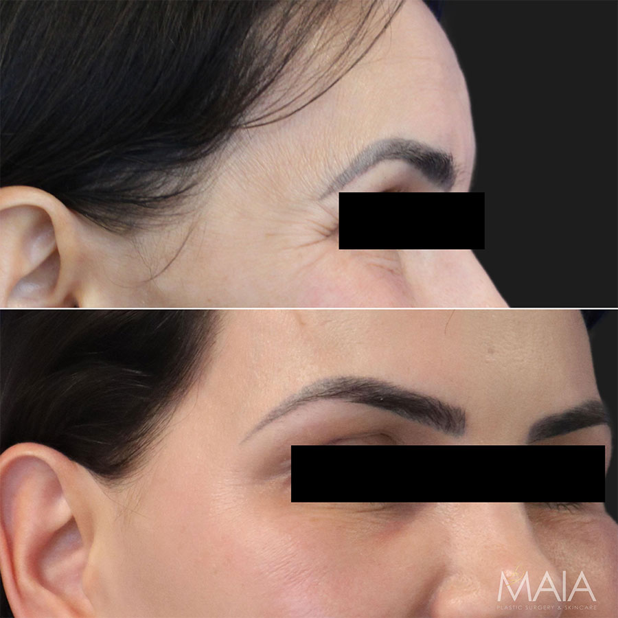 50 year-old female before and 2 weeks after Botox of the forehead, glabella, and crow's feet