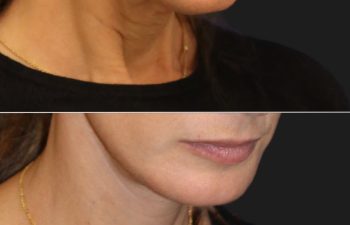 54 year-old patient before and 4 months after a facelift, neck lift, upper eyelid lift, lower eye-bag removal, fat grafting to the face, and a tca peel