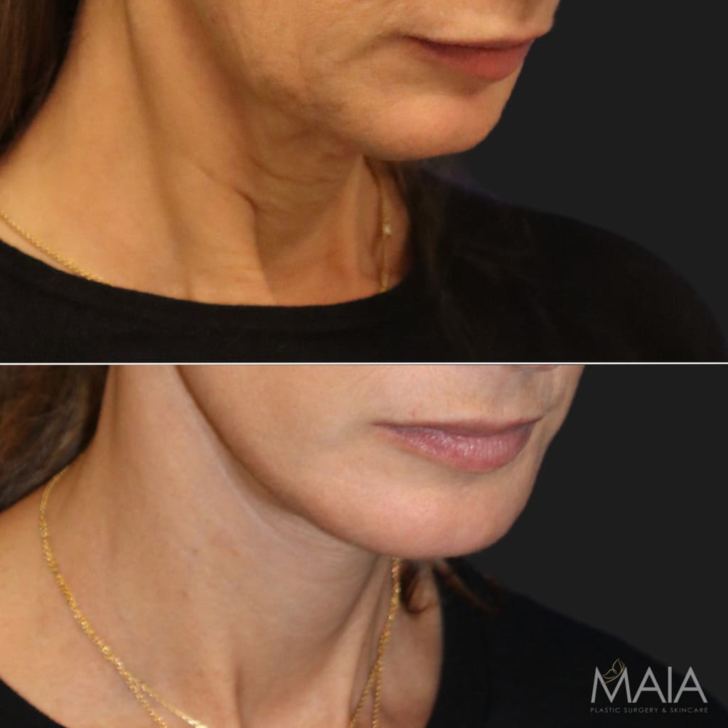 54 year-old patient before and 4 months after a facelift, neck lift, upper eyelid lift, lower eye-bag removal, fat grafting to the face, and a tca peel
