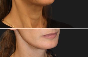 54 year-old patient before and 4 months after a facelift, neck lift, upper eyelid lift, lower eye-bag removal, fat grafting to the face, and a tca peel