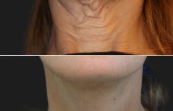 54 year-old patient before and 4 months after a facelift, neck lift, upper eyelid lift, lower eye-bag removal, fat grafting to the face, and a tca peel