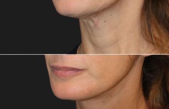 54 year-old patient before and 4 months after a facelift, neck lift, upper eyelid lift, lower eye-bag removal, fat grafting to the face, and a tca peel