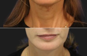 54 year-old patient before and 4 months after a facelift, neck lift, upper eyelid lift, lower eye-bag removal, fat grafting to the face, and a tca peel