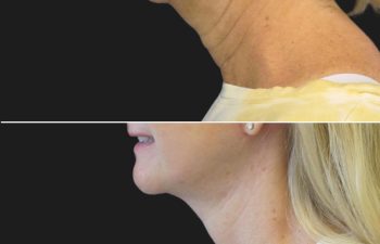 56 year-old, facelift, neck lift, upper and lower blepharoplasty, facial fat grafting, TCA peel and skincare treatment