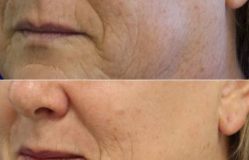 57 year-old before and after one session of CO2 Laser