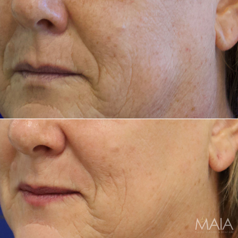 57 year-old before and after one session of CO2 Laser