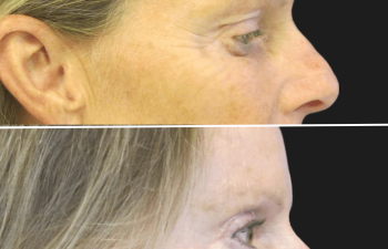 Before and after brow lift procedure