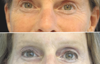 Before and after brow lift procedure