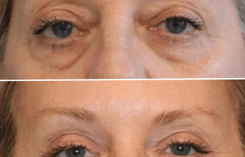 Before and after brow lift procedure