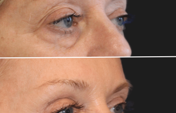 Before and after brow lift procedure
