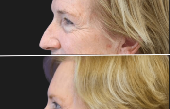 Before and after brow lift procedure