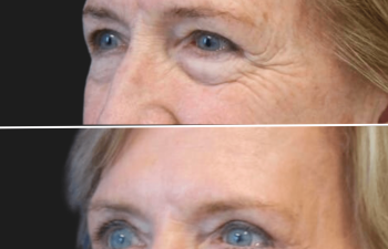 Before and after brow lift procedure