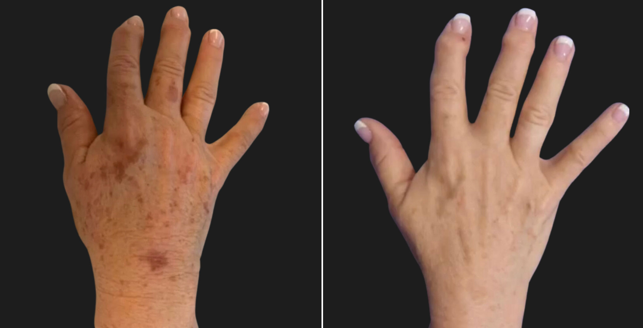 67 year-old before and after 1 session of PicoSure laser on the hands