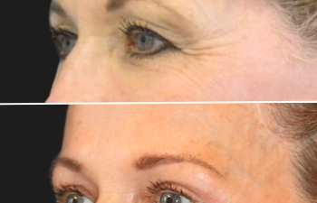 Before and after brow lift procedure