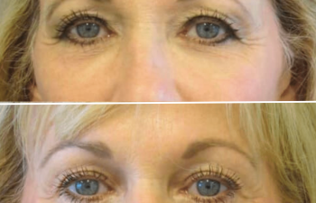 Before and after brow lift procedure