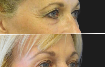 Before and after brow lift procedure