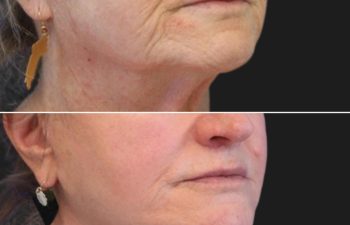 female before and after lip lift
