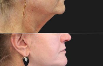 female before and after lip lift