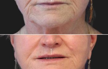 female before and after lip lift