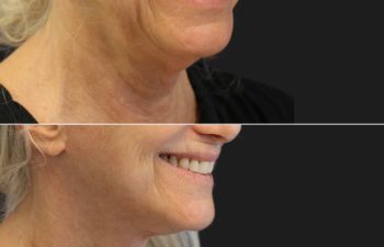 71 year old before and after facelift, neck lift, upper and lower blepharoplasty, canthopexy, fat grafting and TCA peel