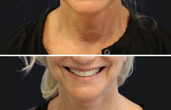 71 year old before and after facelift, neck lift, upper and lower blepharoplasty, canthopexy, fat grafting and TCA peel