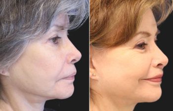 71 year-old patient before and after mini facelift and mini neck lift