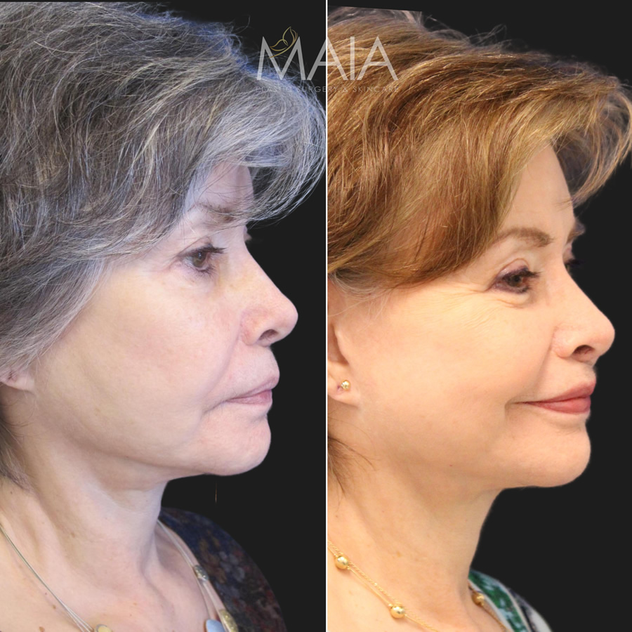 71 year-old patient before and after mini facelift and mini neck lift