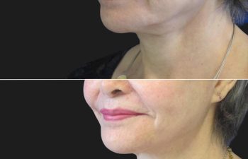 71 year-old patient before and after mini facelift and neck lift