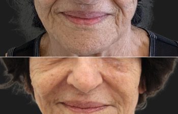 86 year-old patient before and after a "Liquid Facelift": Botox; Filler in the Cheeks, Nasolabial Folds and Marionette Lines