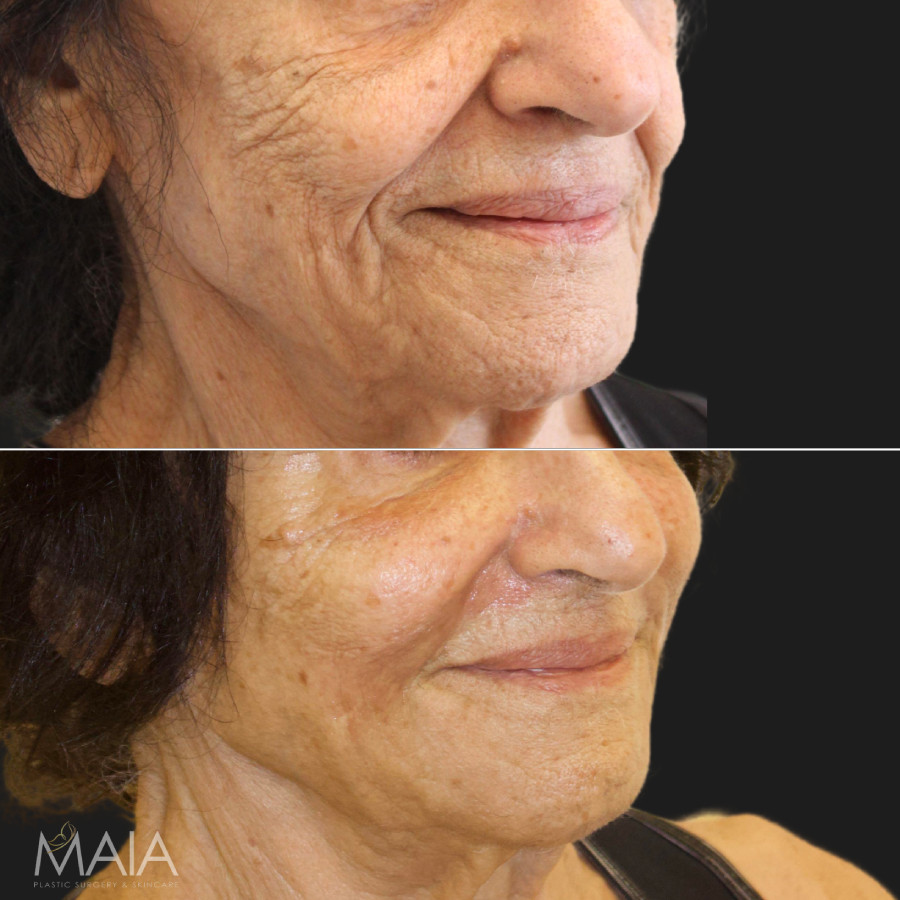 86 year-old patient before and after a 