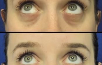 Before and after under-eye filler