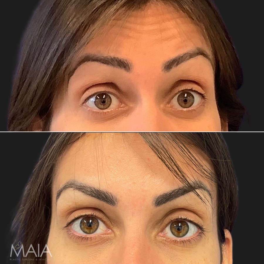 Patient Before and After Botox to the Forehead