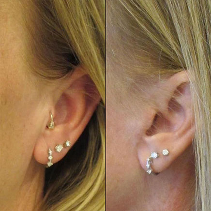 Before Facelift | After Facelift