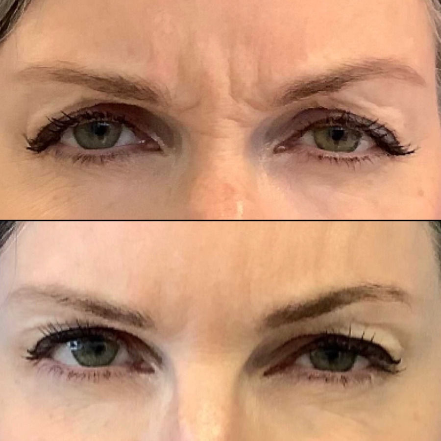 Patient Before and After Botox to the Glabella and Crow's Feet