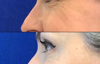 Patient Before and After Botox to the Glabella and Crow's Feet