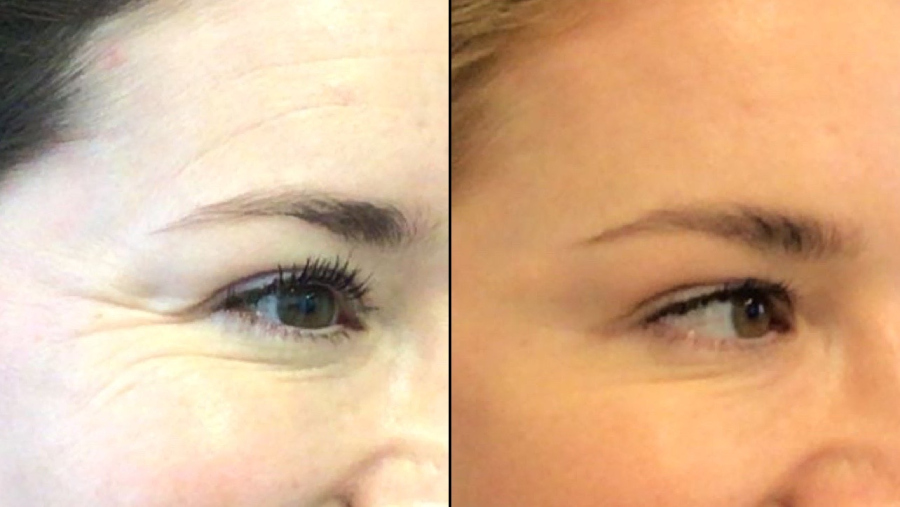 Patient Before and After Crow's Feet Botox