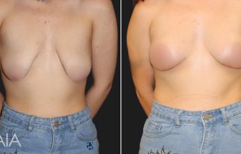 20 year-old before and 4 weeks after a breast lift